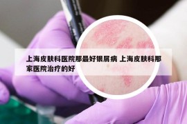 上海皮膚科醫(yī)院那最好銀屑病 上海皮膚科那家醫(yī)院治療的好