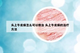 頭上牛皮癬怎么可以根治 頭上牛皮癬的治療方法