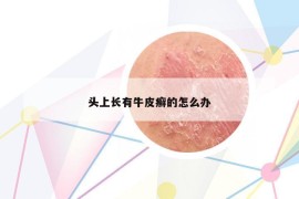頭上長有牛皮癬的怎么辦