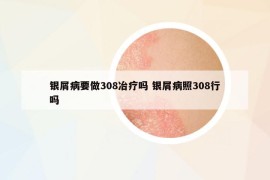 銀屑病要做308冶療嗎 銀屑病照308行嗎
