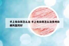 手上有白斑怎么治 手上有白斑怎么治貴州白癩風(fēng)醫(yī)院好