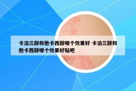 卡泊三醇和他卡西醇哪個效果好 卡泊三醇和他卡西醇哪個效果好貼吧