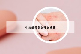 牛皮癬是怎么什么癥狀