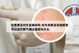吃煮黃豆對牛皮癬好嗎 吃牛肉黃豆及粗糧等可以治療腳氣病這是因為什么