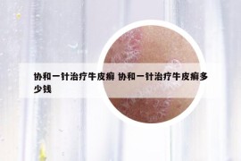 協(xié)和一針治療牛皮癬 協(xié)和一針治療牛皮癬多少錢