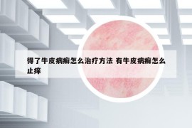 得了牛皮病癬怎么治療方法 有牛皮病癬怎么止癢