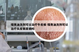 煤焦油洗劑可以治療牛皮癬 煤焦油洗劑可以治療頭皮銀屑病嗎