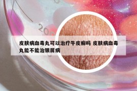 皮膚病血毒丸可以治療牛皮癬嗎 皮膚病血毒丸能不能治銀屑病