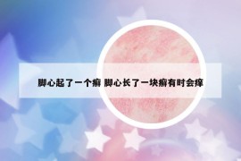 腳心起了一個(gè)癬 腳心長了一塊癬有時(shí)會(huì)癢