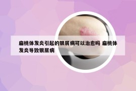 扁桃體發(fā)炎引起的銀屑病可以治愈嗎 扁桃體發(fā)炎導(dǎo)致銀屑病