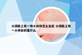 小孩臉上有一塊小白塊怎么治愈 小孩臉上有一小塊白的是什么