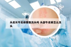 頭皮長牛皮癬要勤洗頭嗎 頭部牛皮癬怎么洗頭