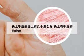 頭上牛皮癬身上有幾個怎么辦 頭上有牛皮癬的癥狀