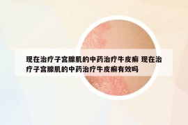 現(xiàn)在治療子宮腺肌的中藥治療牛皮癬 現(xiàn)在治療子宮腺肌的中藥治療牛皮癬有效嗎