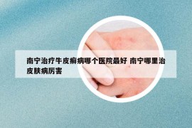 南寧治療牛皮癬病哪個醫(yī)院最好 南寧哪里治皮膚病厲害