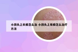 小孩頭上長癬怎么治 小孩頭上有癬怎么治療方法