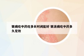 銀病吃中藥吃多長(zhǎng)時(shí)間能好 銀消病吃中藥多久見(jiàn)效