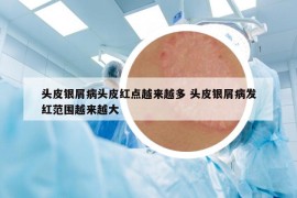 頭皮銀屑病頭皮紅點(diǎn)越來越多 頭皮銀屑病發(fā)紅范圍越來越大