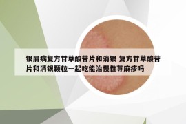 銀屑病復(fù)方甘草酸苷片和消銀 復(fù)方甘草酸苷片和消銀顆粒一起吃能治慢性蕁麻疹嗎