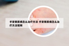 手背銀屑病怎么治療方法 手背銀屑病怎么治療方法視頻