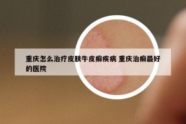 重慶怎么治療皮膚牛皮癬疾病 重慶治癬最好的醫(yī)院