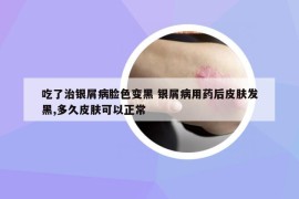 吃了治銀屑病臉色變黑 銀屑病用藥后皮膚發(fā)黑,多久皮膚可以正常