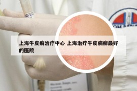 上海牛皮癬治療中心 上海治療牛皮病癬最好的醫(yī)院