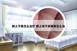 腳上干癬怎么治療 腳上有干皮腳癬怎么治
