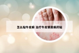 怎么貼牛皮癬 治療牛皮銀屑癬藥貼