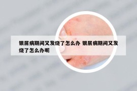 銀屑病期間又發(fā)燒了怎么辦 銀屑病期間又發(fā)燒了怎么辦呢