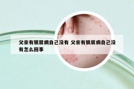 父親有銀屑病自己沒有 父親有銀屑病自己沒有怎么回事