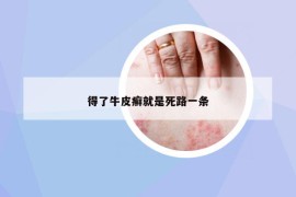 得了牛皮癬就是死路一條