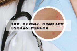 頭皮有一部分是顏色不一樣是癬嗎 頭皮有一部分是顏色不一樣是癬嗎圖片
