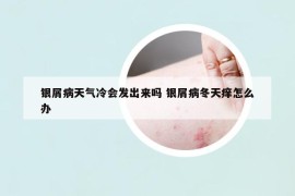 銀屑病天氣冷會發(fā)出來嗎 銀屑病冬天癢怎么辦