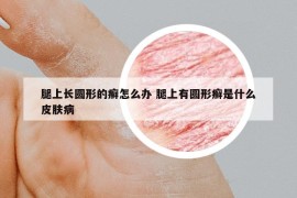 腿上長圓形的癬怎么辦 腿上有圓形癬是什么皮膚病
