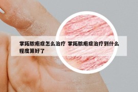 掌跖膿皰癥怎么治療 掌跖膿皰癥治療到什么程度算好了