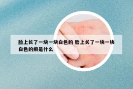 臉上長(zhǎng)了一塊一塊白色的 臉上長(zhǎng)了一塊一塊白色的癬是什么