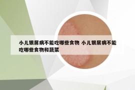 小兒銀屑病不能吃哪些食物 小兒銀屑病不能吃哪些食物和蔬菜