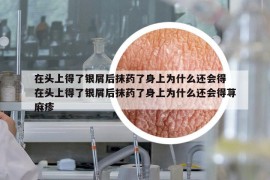 在頭上得了銀屑后抹藥了身上為什么還會(huì)得 在頭上得了銀屑后抹藥了身上為什么還會(huì)得蕁麻疹
