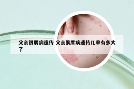 父親銀屑病遺傳 父親銀屑病遺傳幾率有多大了