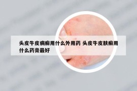 頭皮牛皮病癬用什么外用藥 頭皮牛皮膚癬用什么藥膏最好