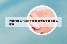 大黃和什么一起治牛皮癬 大黃和牛黃有什么區(qū)別