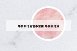 牛皮癬泡浴管不管用 牛皮癬泡澡