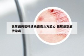 銀屑病傳染嗎速來西安北方放心 銀屑病到底傳染嗎