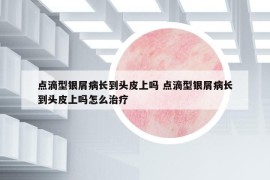 點滴型銀屑病長到頭皮上嗎 點滴型銀屑病長到頭皮上嗎怎么治療