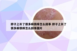 脖子上長了很多癬很癢怎么回事 脖子上長了很多癬很癢怎么回事圖片