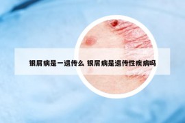 銀屑病是一遺傳么 銀屑病是遺傳性疾病嗎