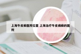 上海牛皮癬醫(yī)院位置 上海治療牛皮病癬的醫(yī)院