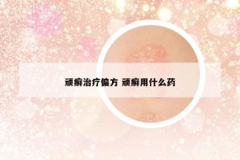 頑癬治療偏方 頑癬用什么藥