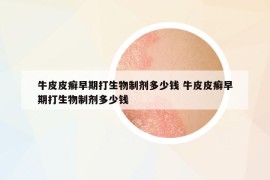 牛皮皮癬早期打生物制劑多少錢 牛皮皮癬早期打生物制劑多少錢